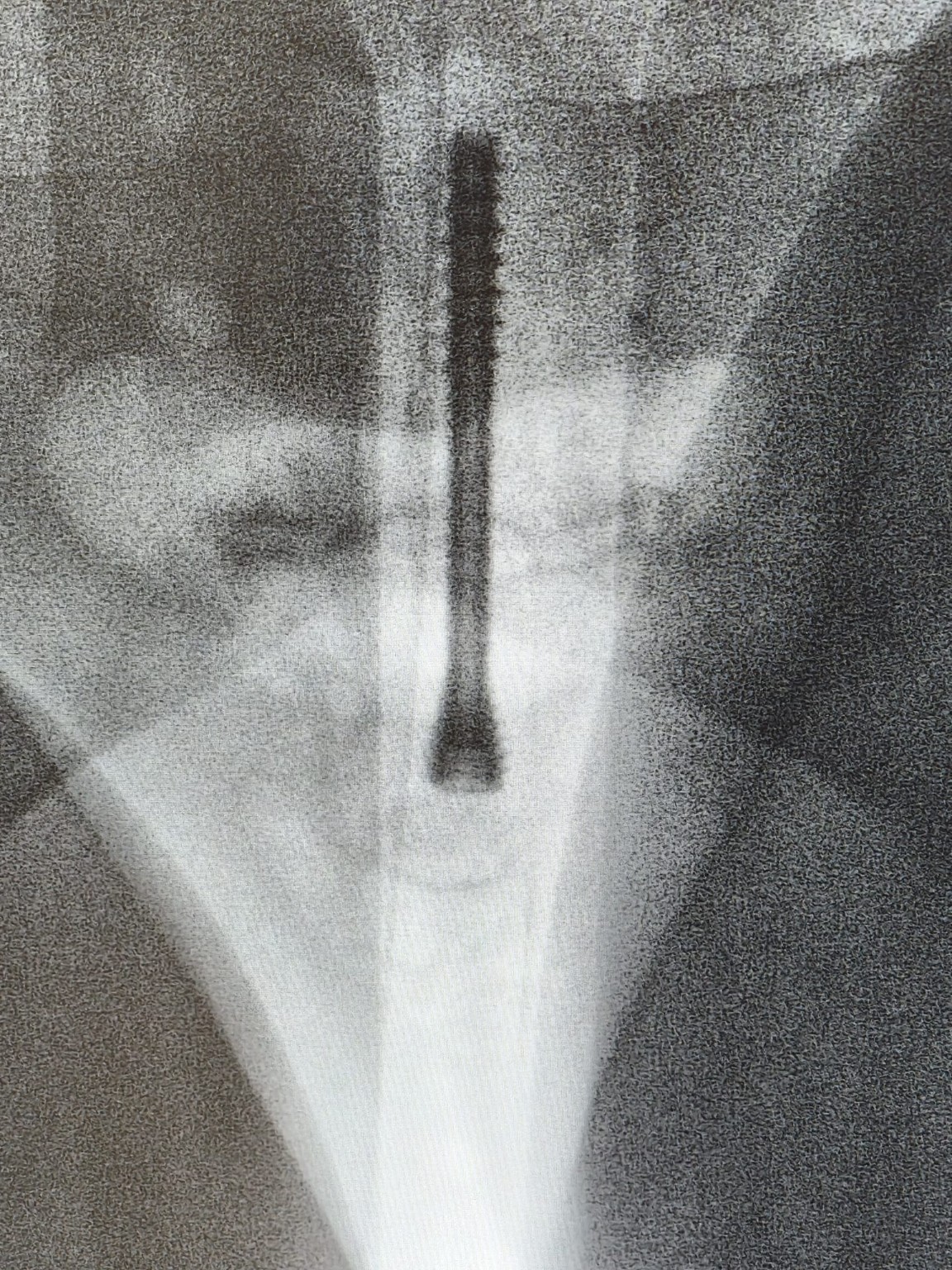Imagen radiológica de fijación, proyección 1